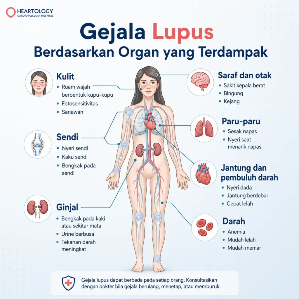 Infografis gejala lupus berdasarkan organ yang terdampak, mencakup ruam kulit, nyeri sendi, gangguan ginjal, sesak napas, nyeri dada, anemia, sakit kepala, dan kejang.