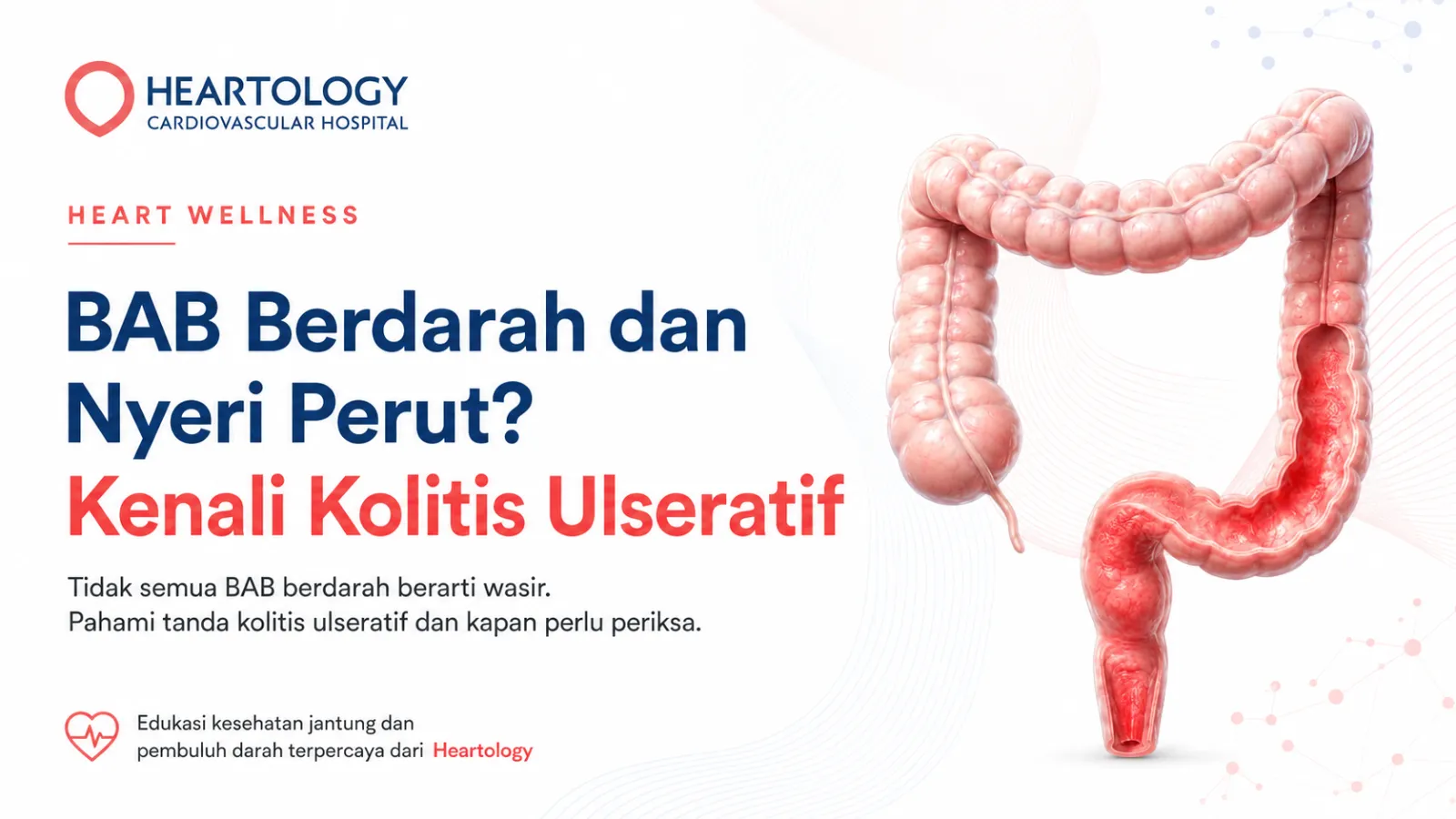 Apa Itu Ulcerative Colitis atau Kolitis Ulseratif? Gejala, Penyebab, dan Penanganannya