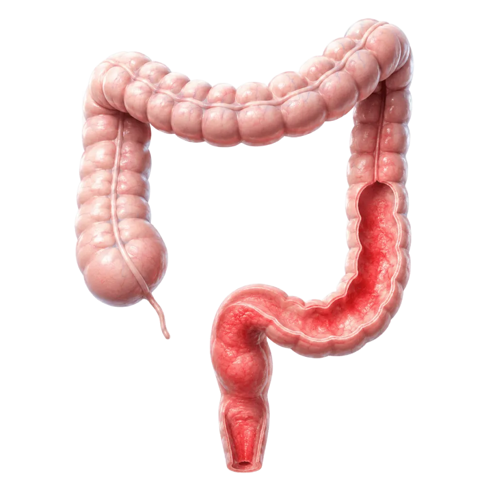 Ilustrasi medis 3D usus besar dan rektum dengan sorotan peradangan pada lapisan dalam kolon, menggambarkan kolitis ulseratif secara edukatif untuk artikel kesehatan Heartology.