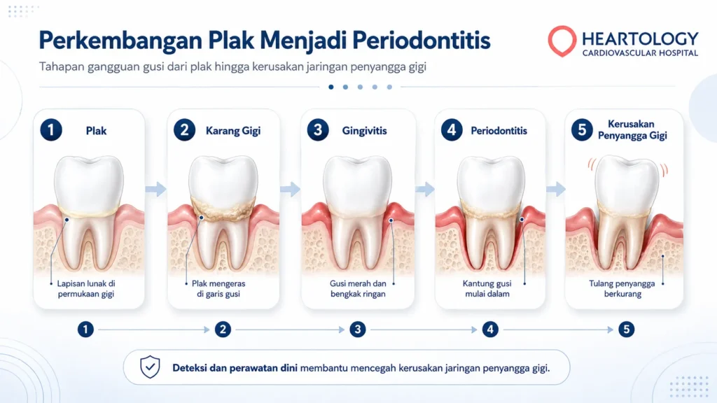 Infografik Heartology tentang perkembangan plak menjadi periodontitis yang menampilkan tahapan plak, karang gigi, gingivitis, periodontitis, dan kerusakan jaringan penyangga gigi.