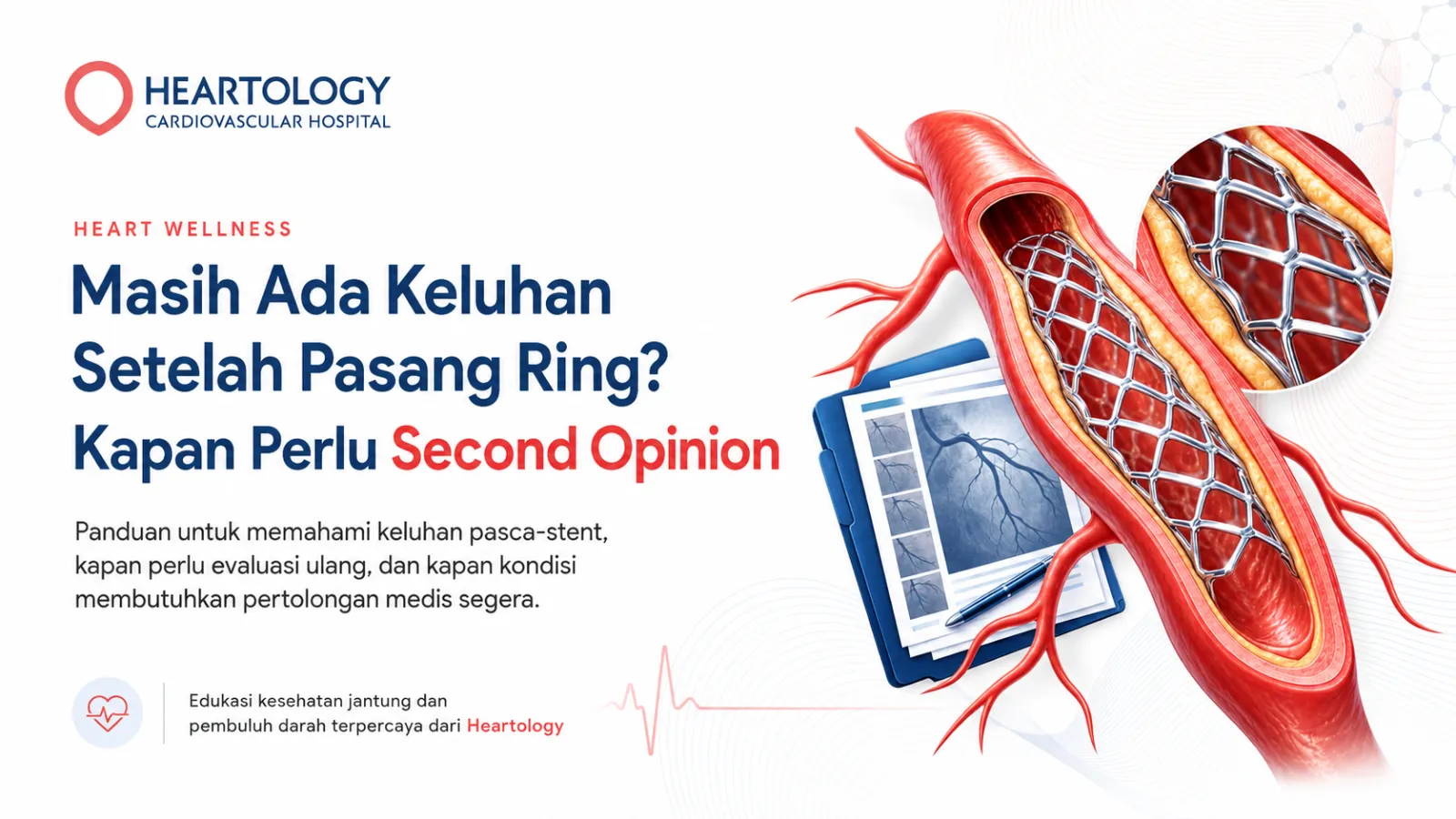 Masih Ada Keluhan Setelah Pasang Ring? Kapan Perlu Second Opinion