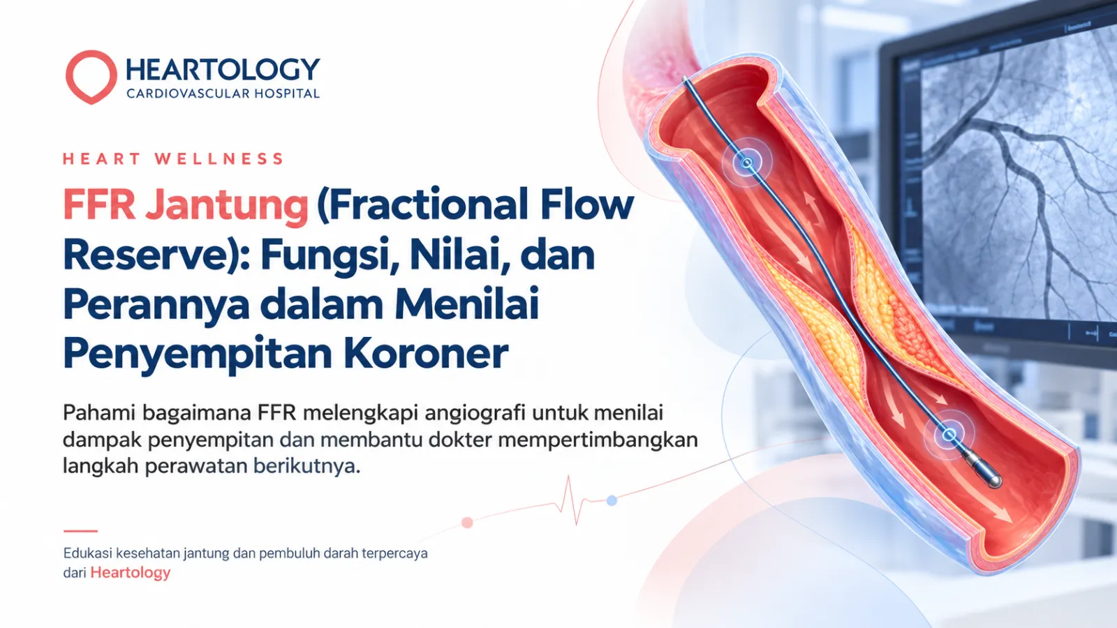 FFR Jantung (Fractional Flow Reserve): Fungsi, Nilai, dan Perannya dalam Menilai Penyempitan Koroner